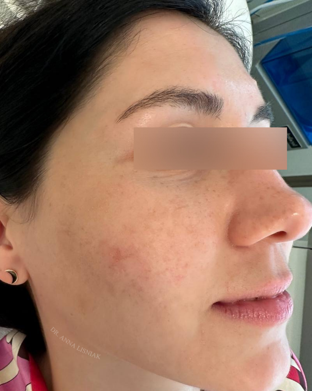 After acne treatment