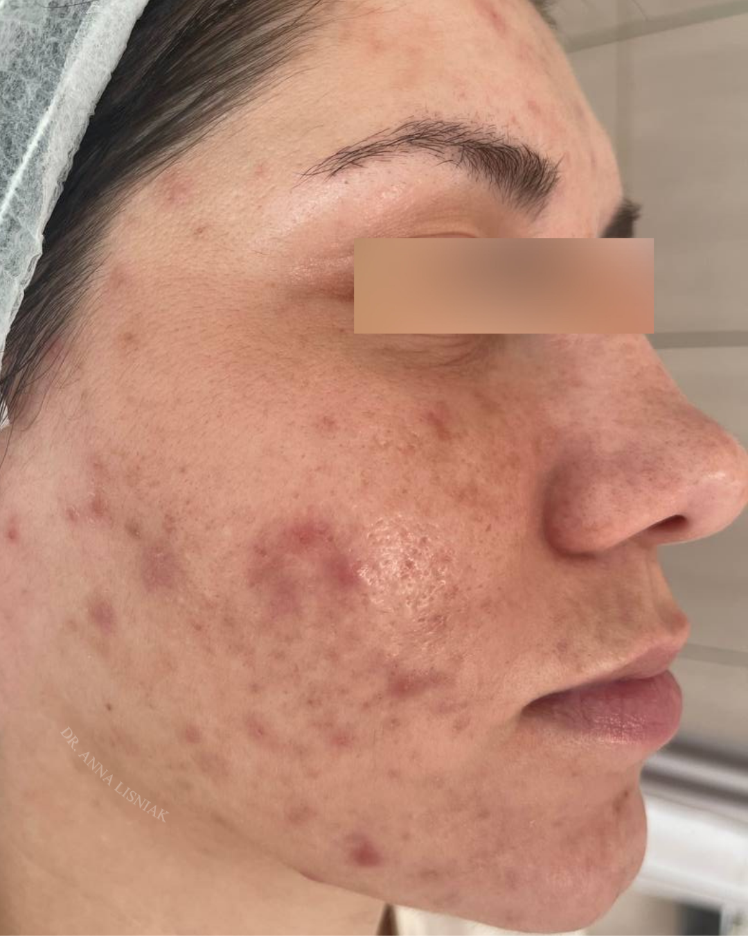 Before acne treatment