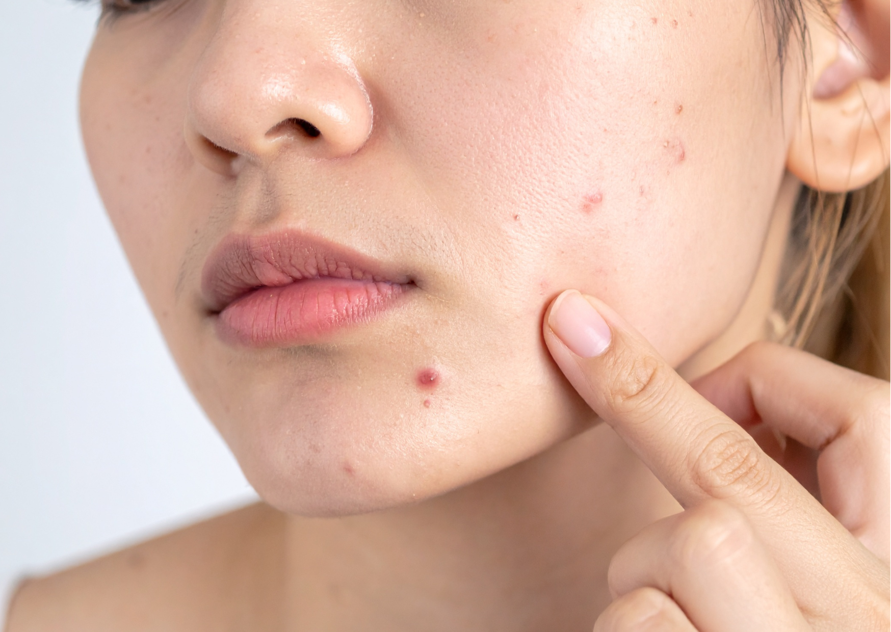 Combatting Acne