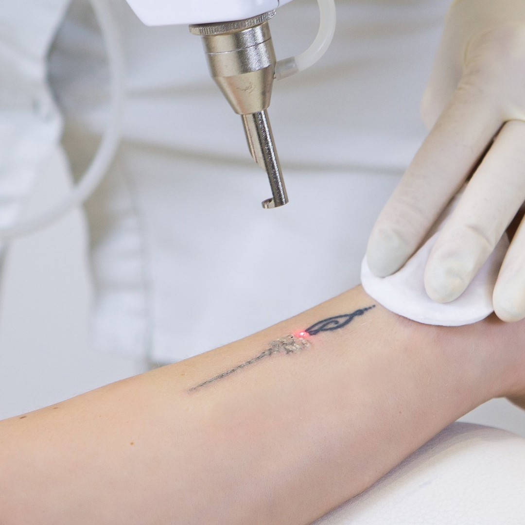 Tattoo Removal